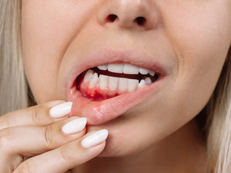 bleeding gums treatment