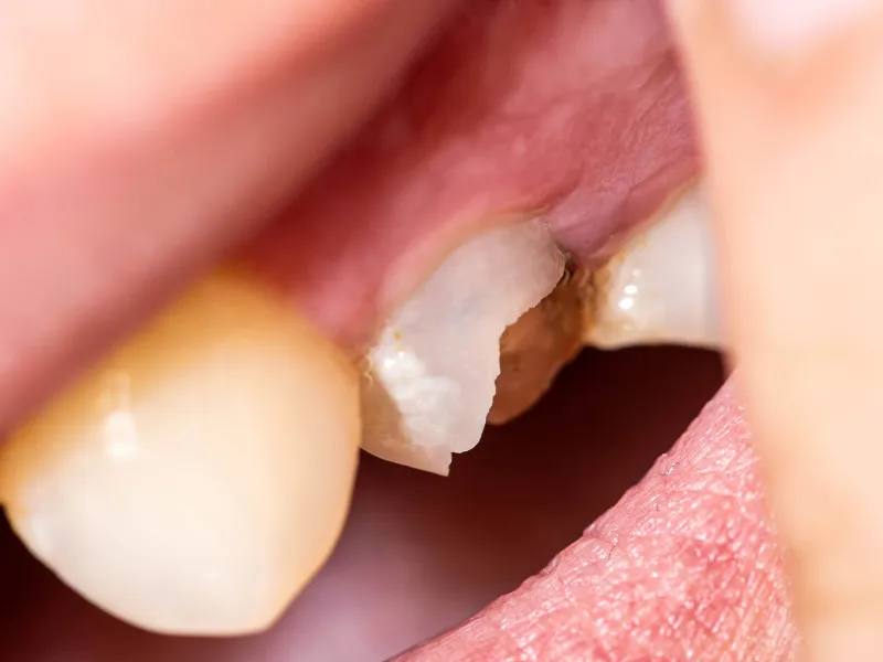chipped tooth repair