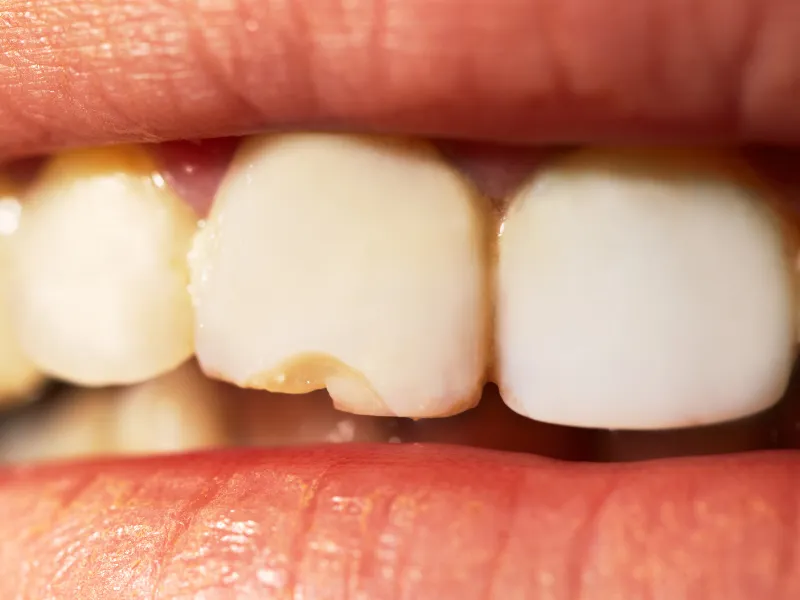 cracked tooth repair