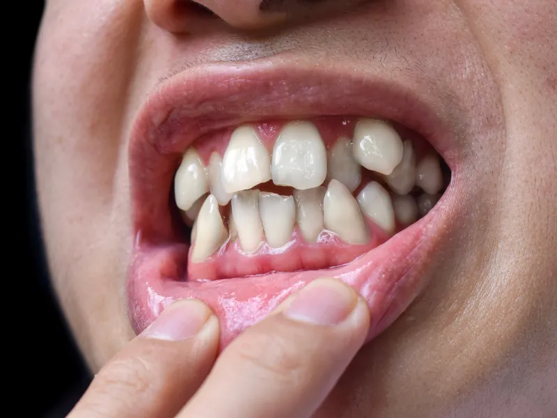 dental bonding