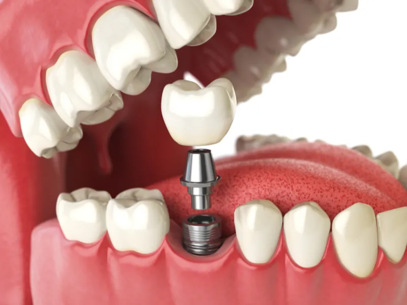 dental bridge