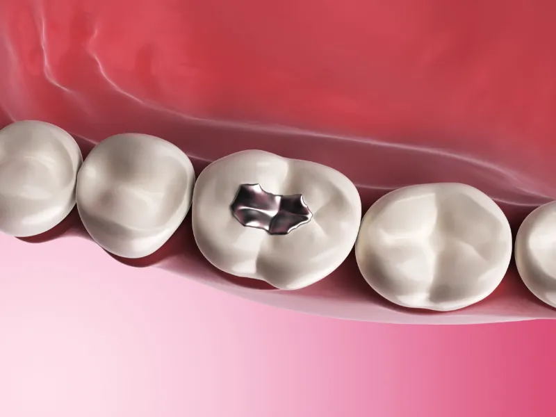dental fillings