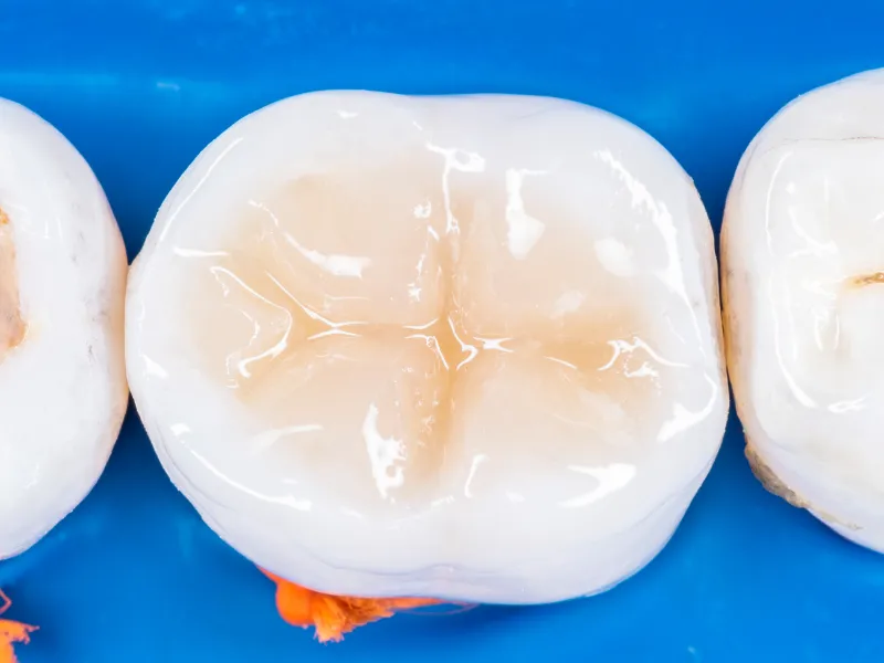 dental sealants