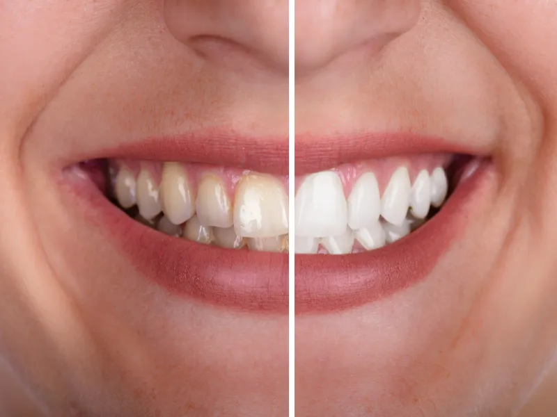 porcelain veneers before and after
