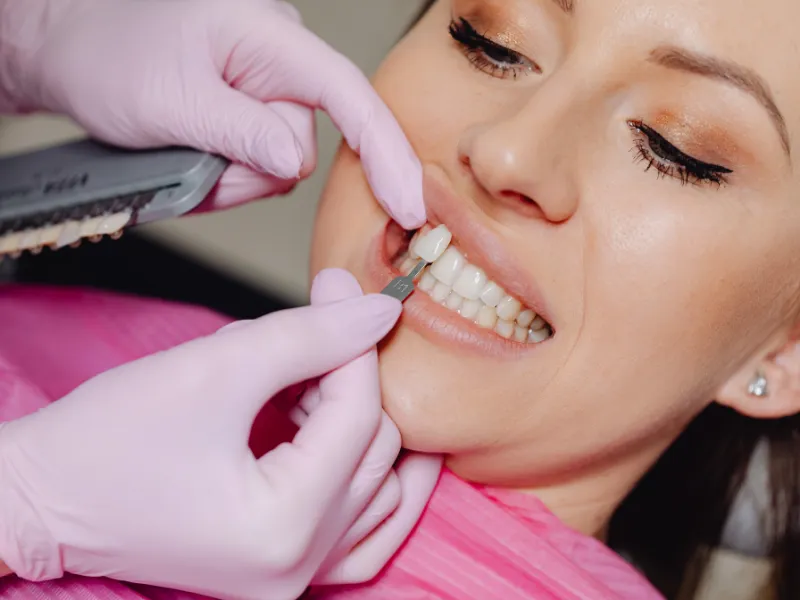 porcelain veneers