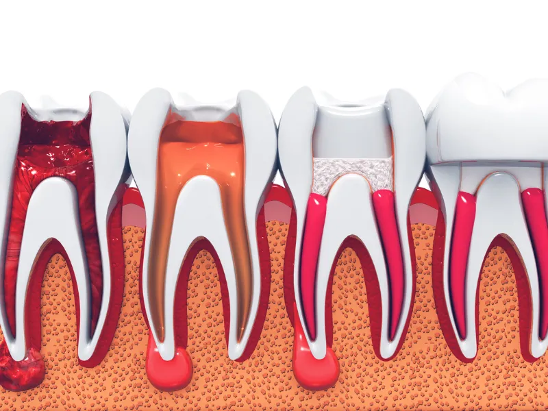 root canal treatment
