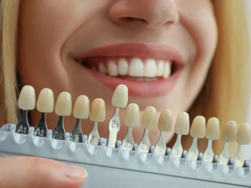 teeth porcelain veneers