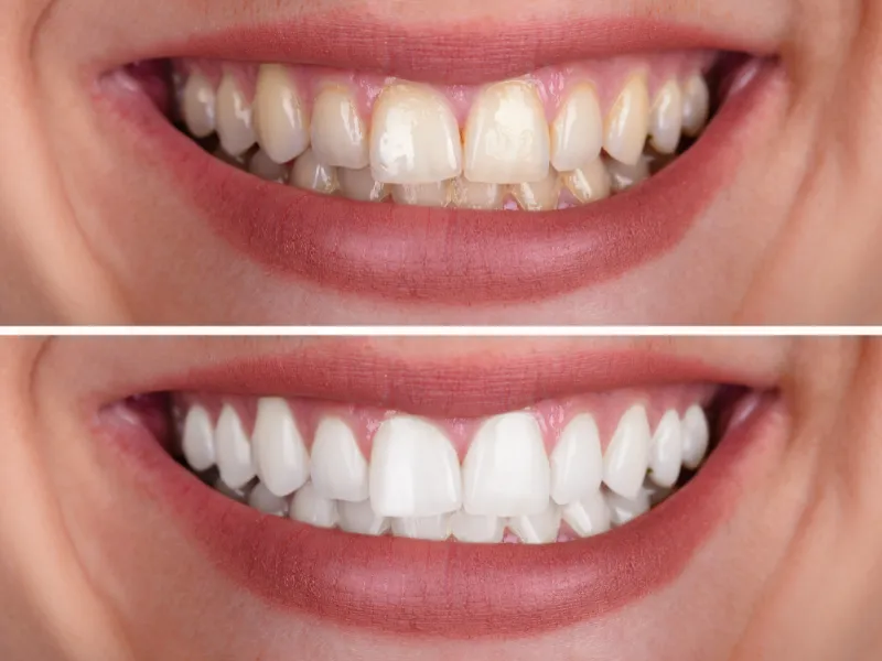 teeth whitening before and after
