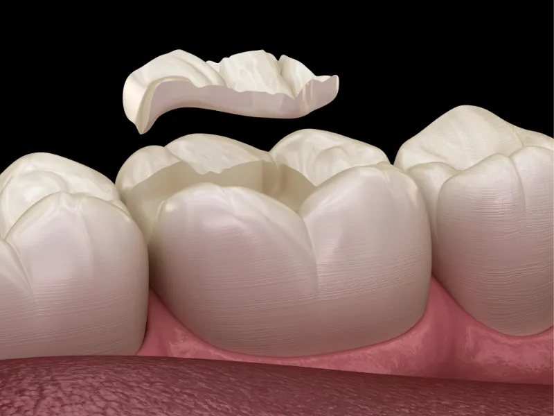 tooth crown