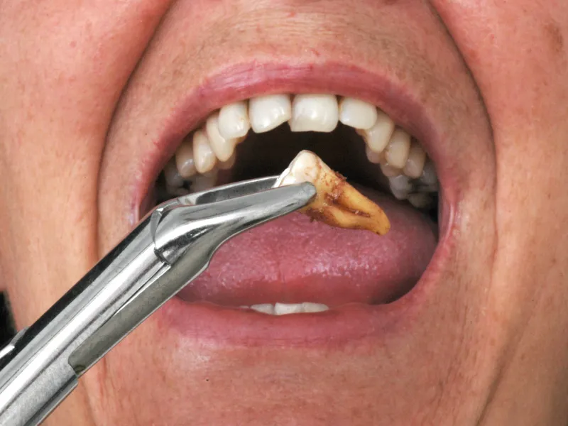 tooth extraction