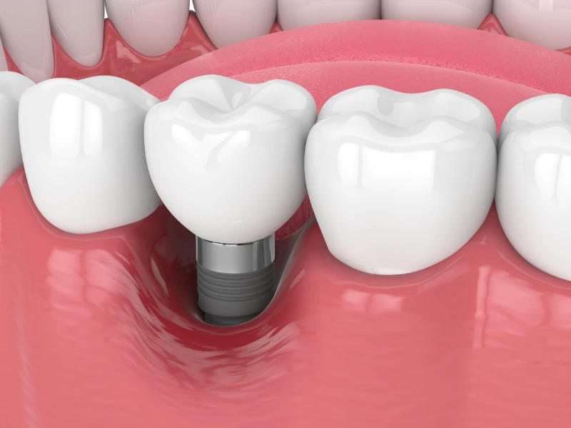 tooth implant cost