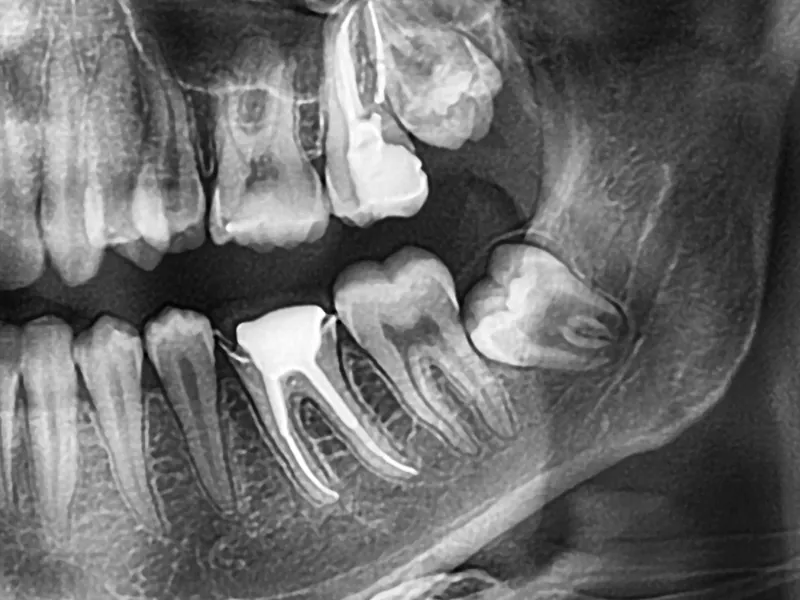 wisdom teeth removal