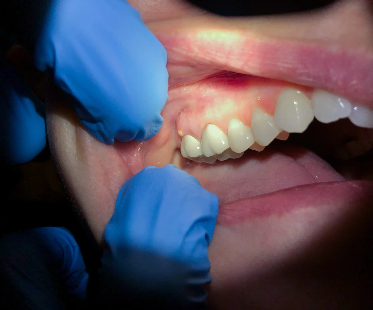abscess tooth removal