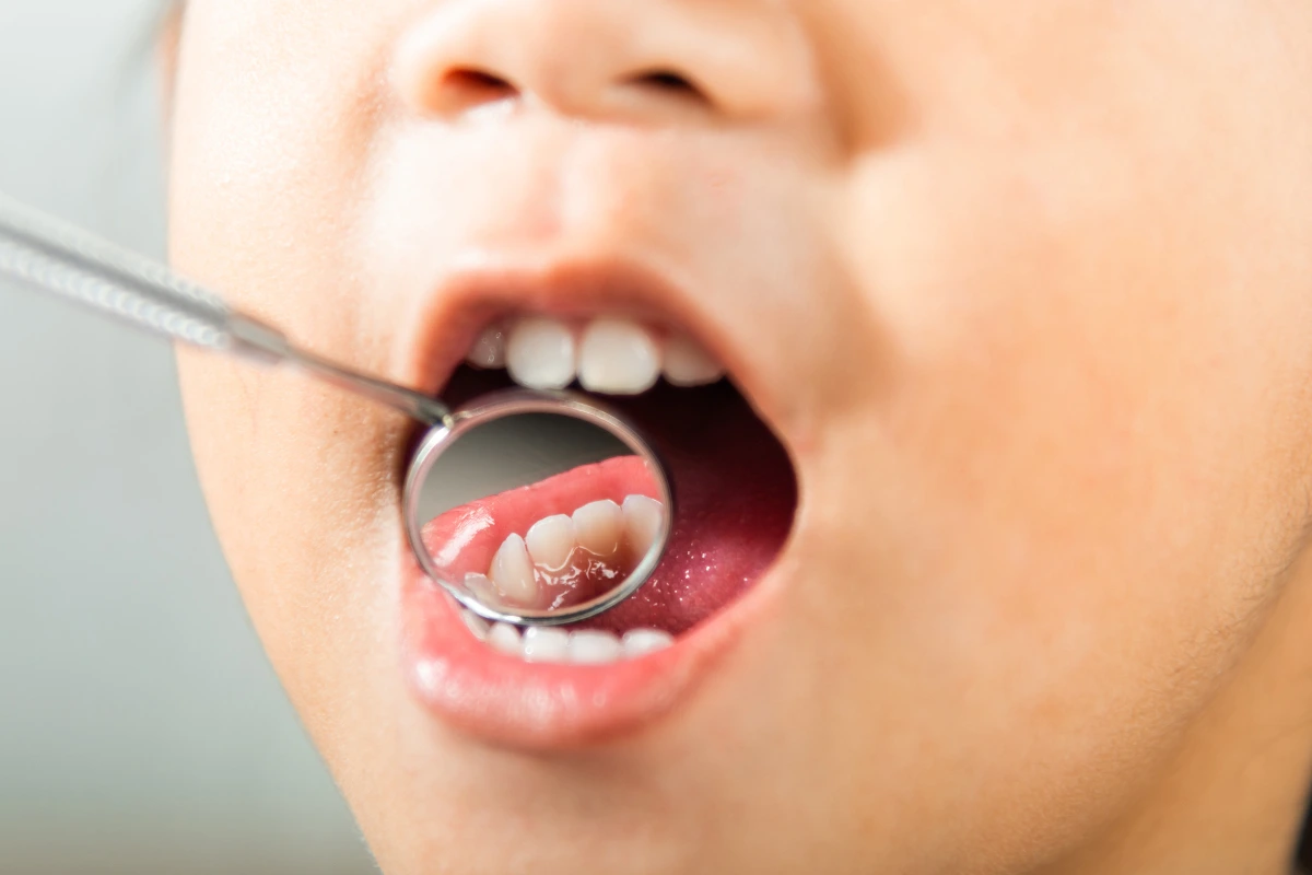 benefits fluoride treatment