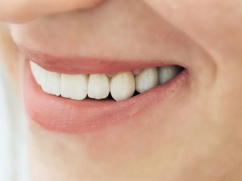 chipped tooth repair cost
