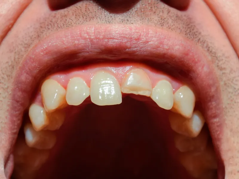chipped tooth repair in magnolia tx