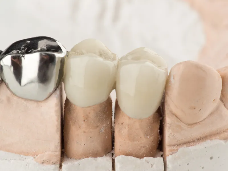 dental bridge treatment