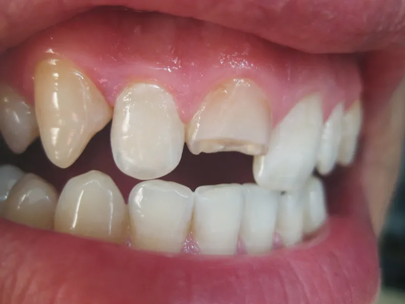 fixing a chipped tooth