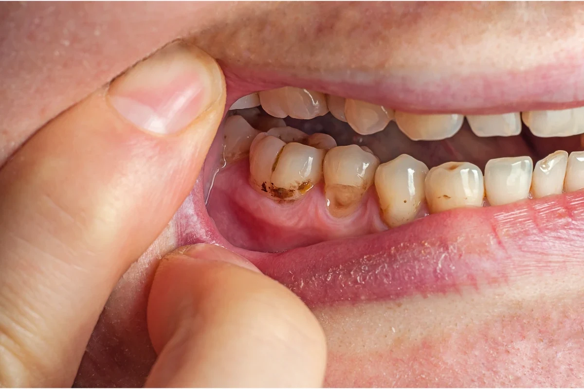 fluoride treatment of teeth