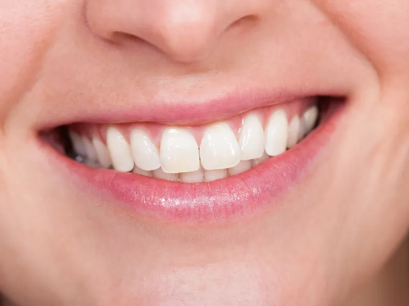 smile makeover before and after