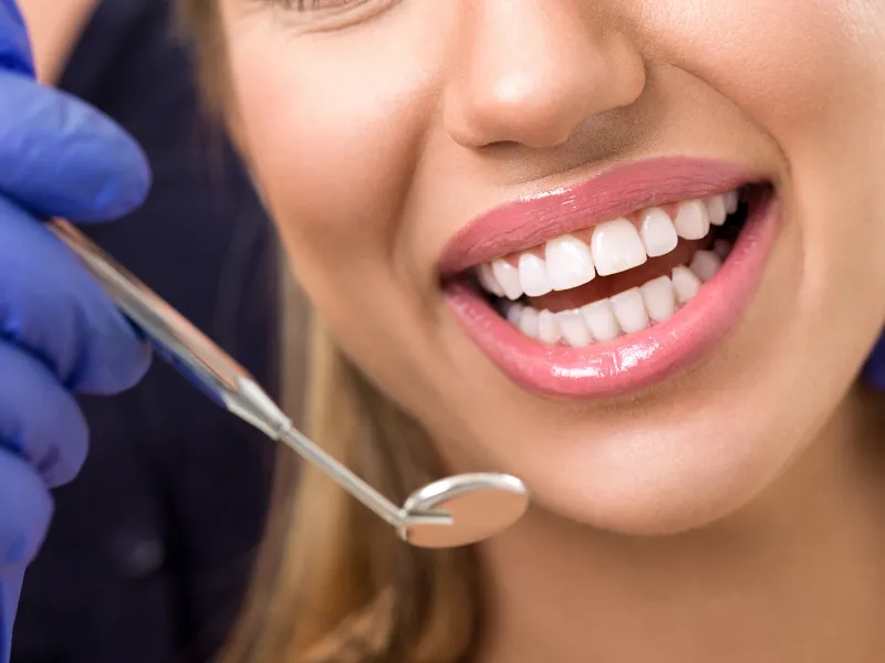 smile makeover