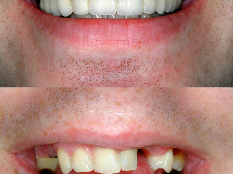 tooth extraction before and after