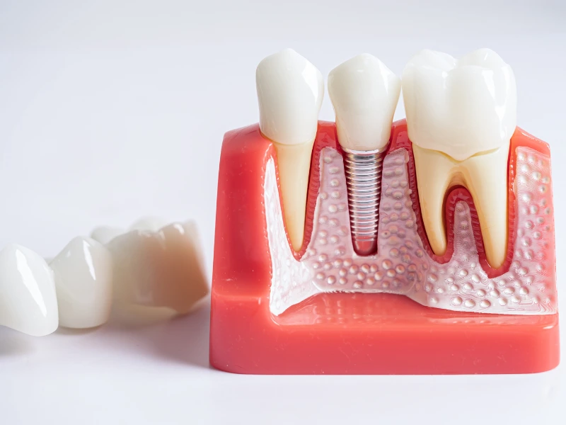 Benefits of Root Canal Treatment
