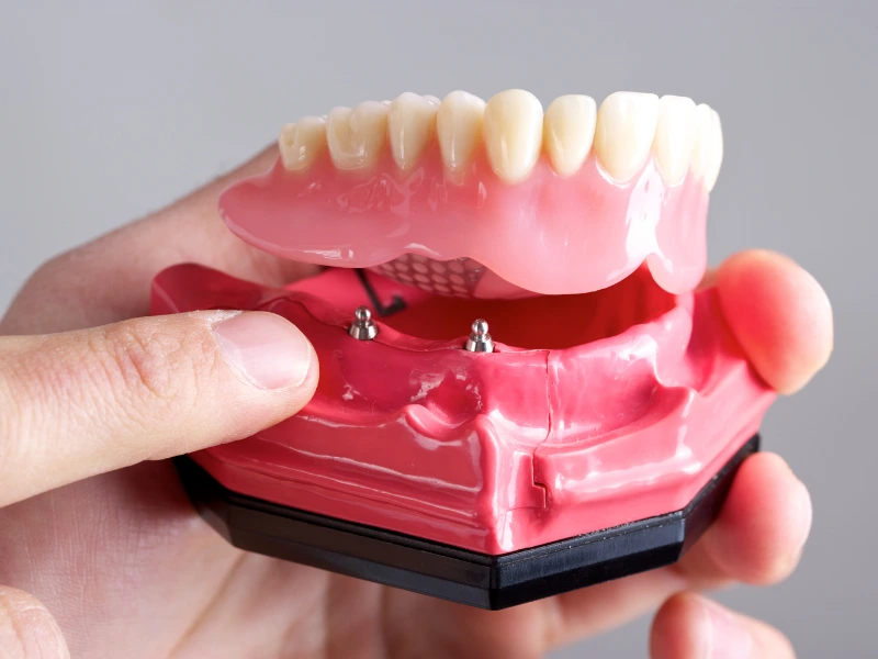 Candidate for Denture Implants