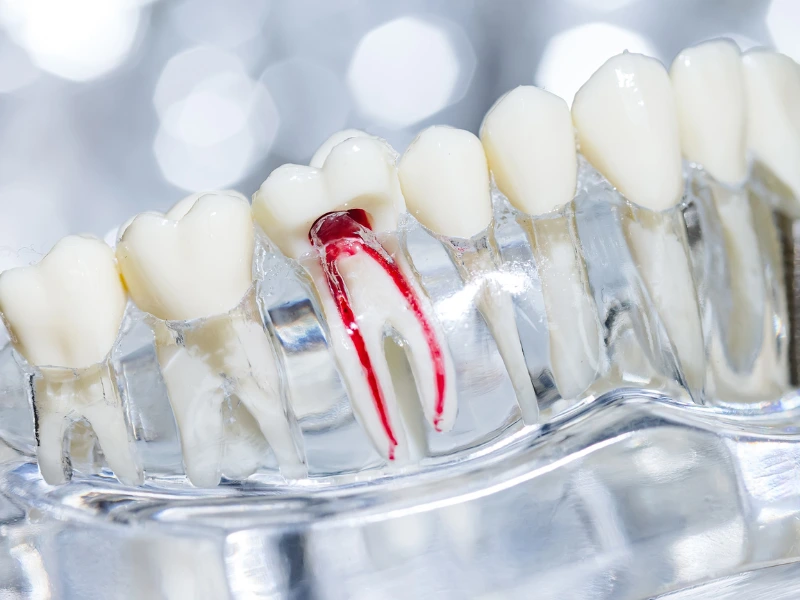 Candidate for Root Canal