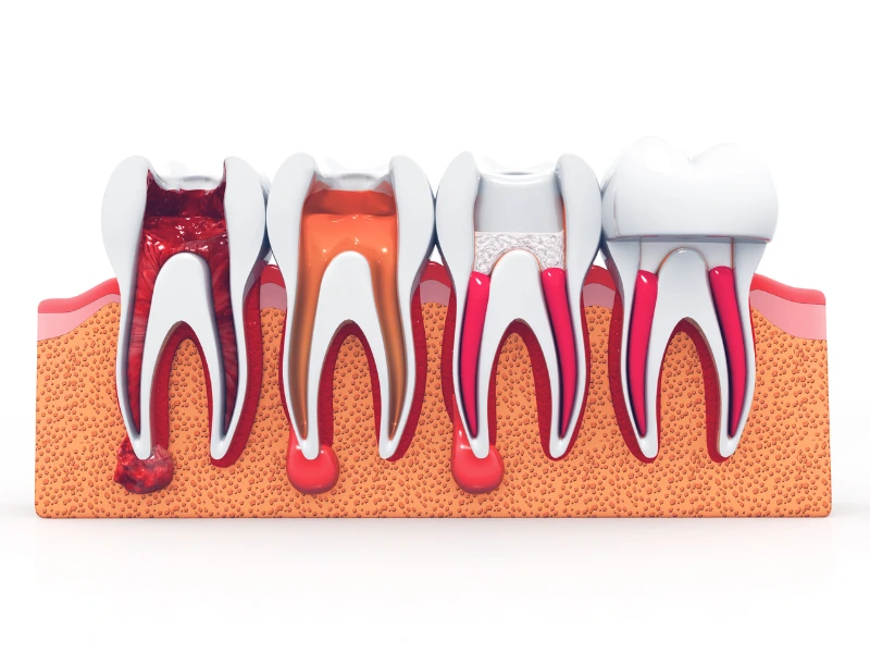 Root Canal Treatment Options