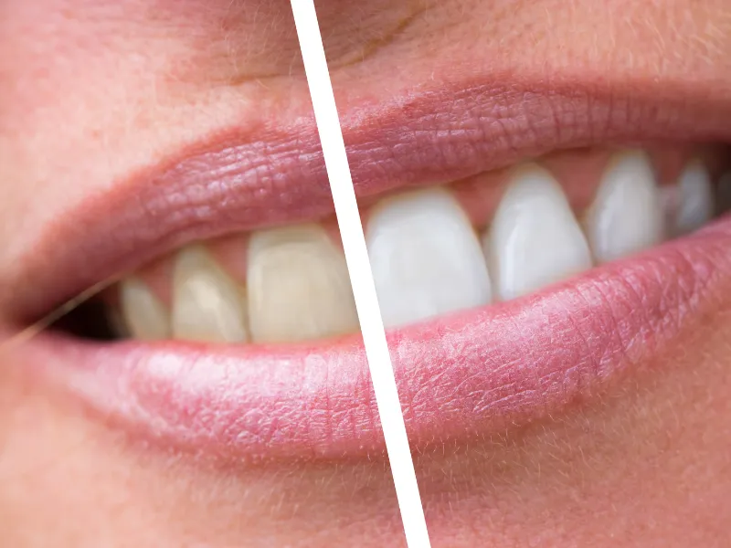 before and after gum treatment