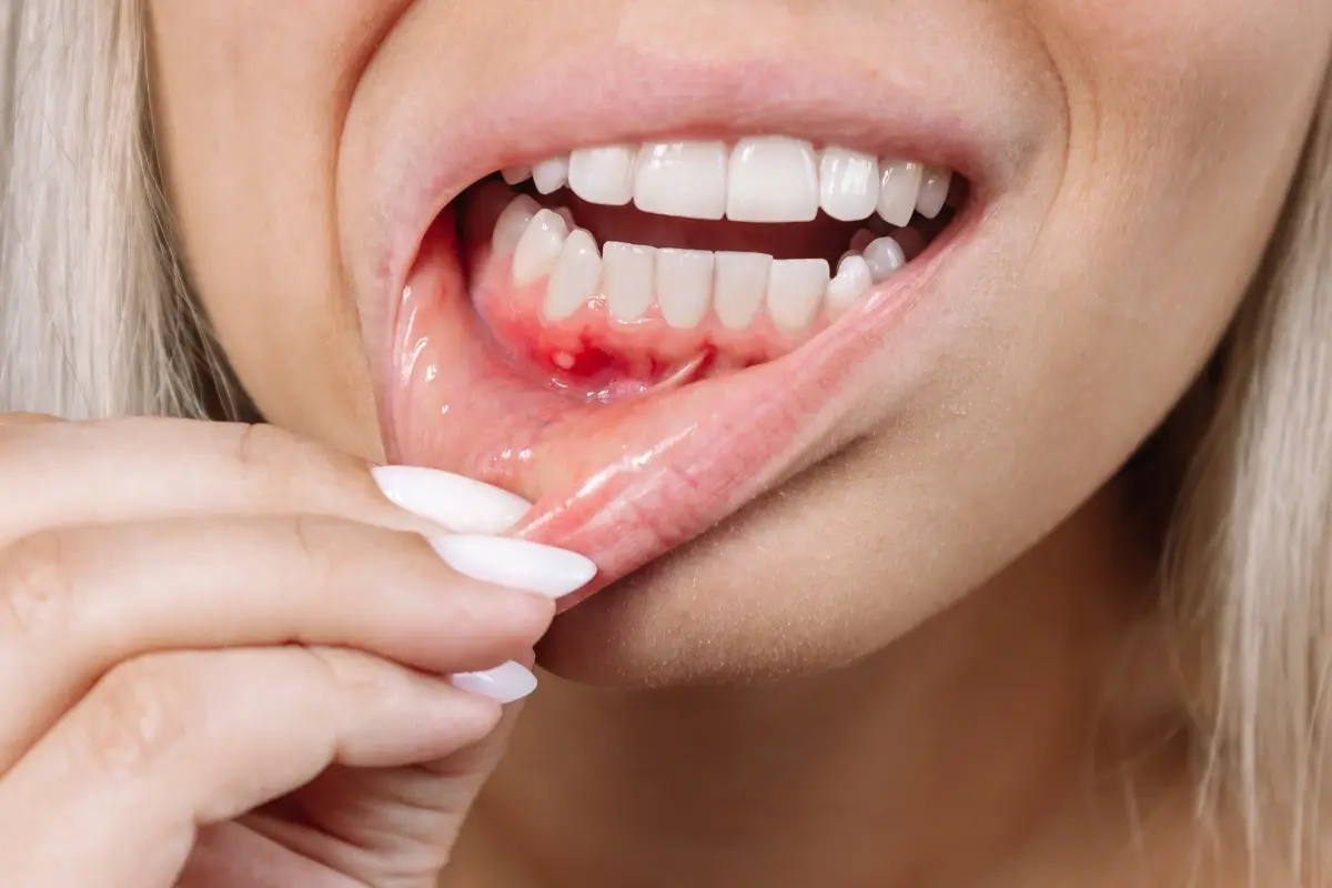 bleeding gums while flossing