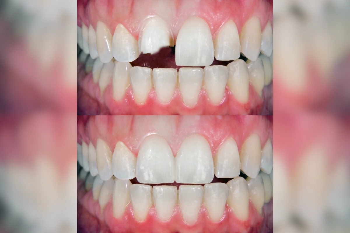 broken tooth repair before and after
