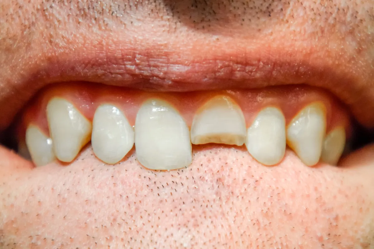broken tooth repair in magnolia