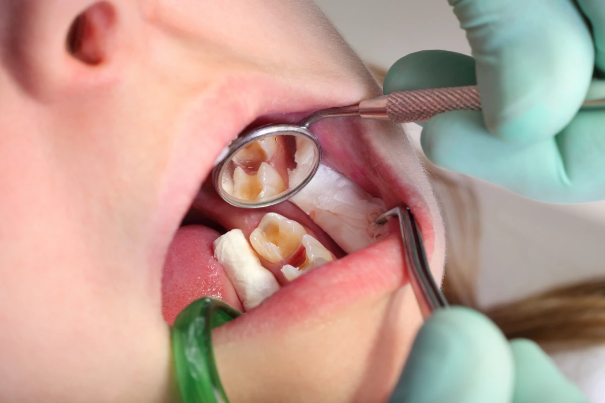 cavity filling cost