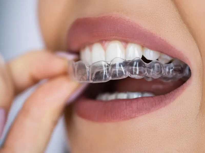 clear aligners magnolia tx