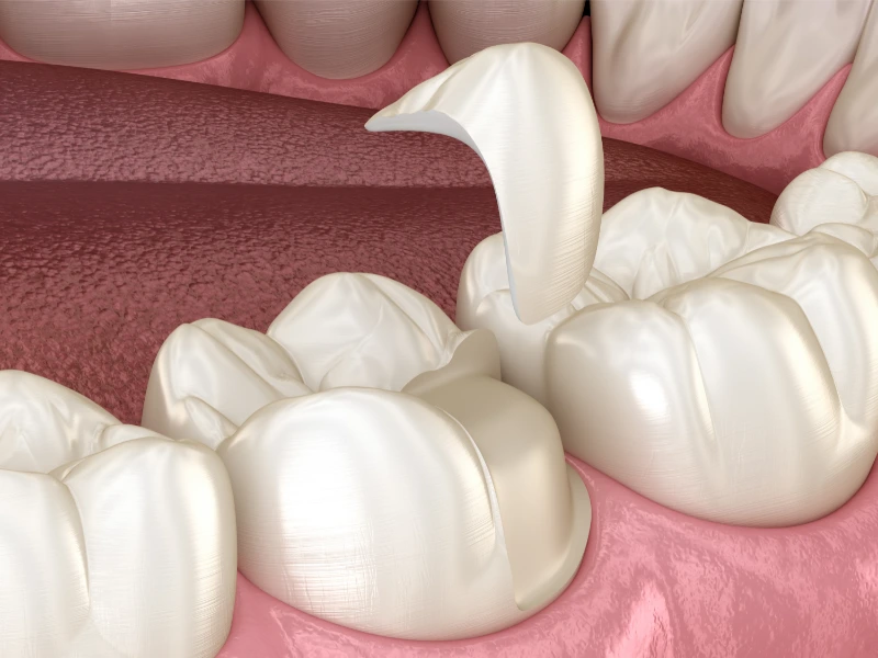 cracked tooth repair in magnolia tx