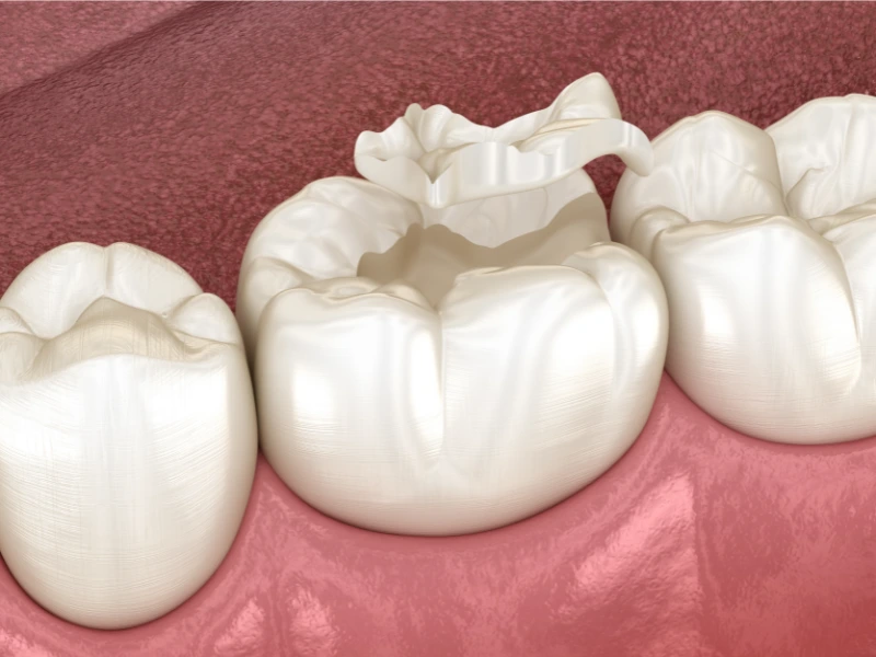 cracked tooth treatment