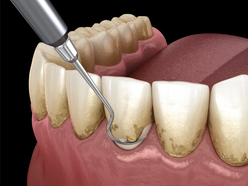 deep dental cleaning magnolia tx