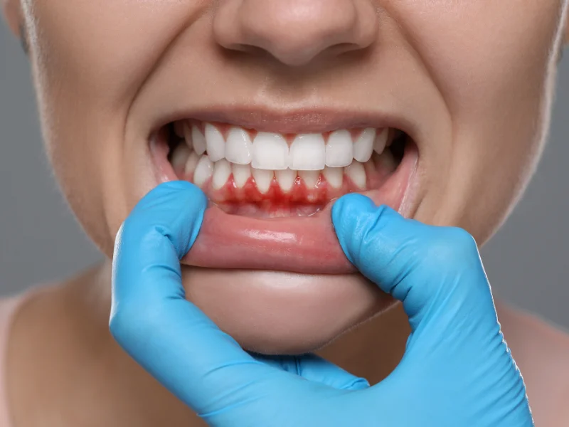 gum bleeding cause
