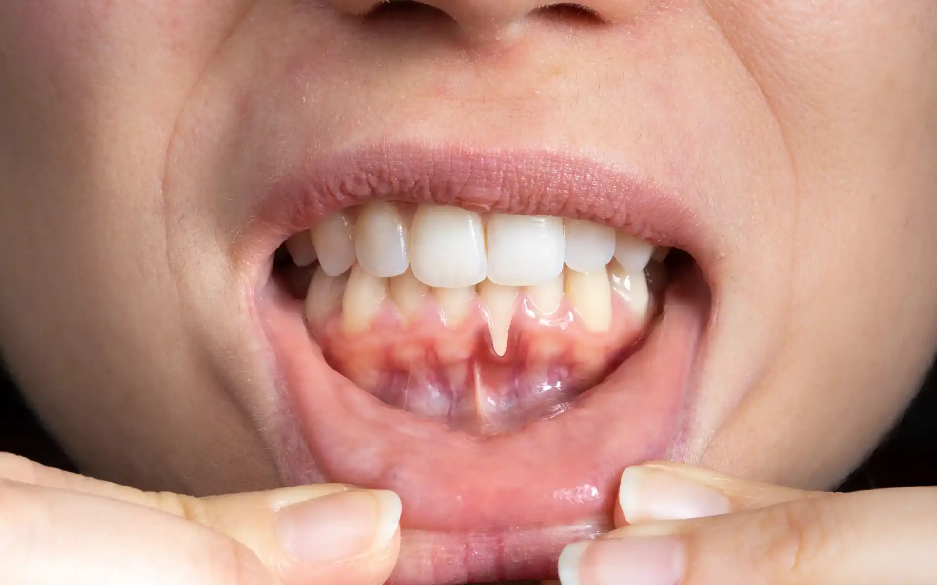 how to stop gum bleeding immediately​