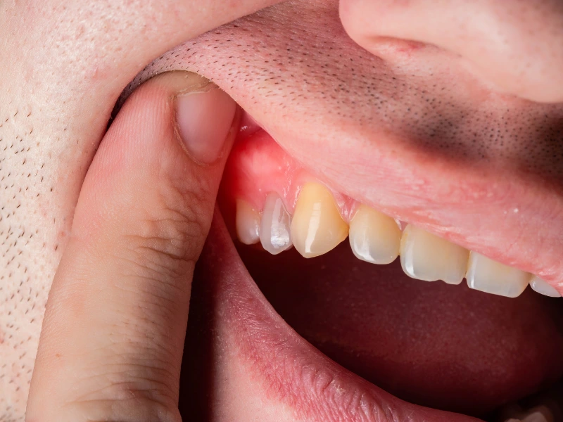 reduce gum inflammation fast