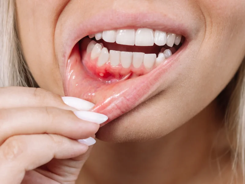 signs of gum disease