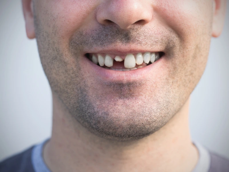 small crack in tooth