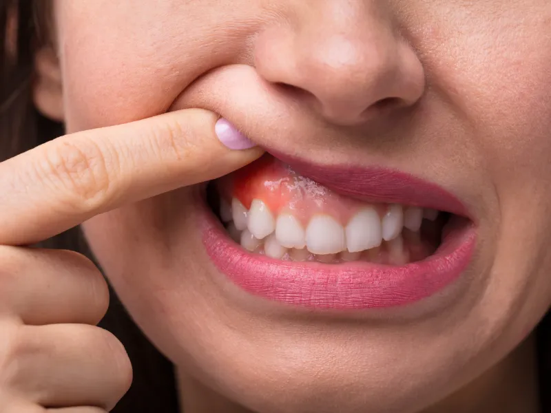 swollen gums treatment in magnolia tx