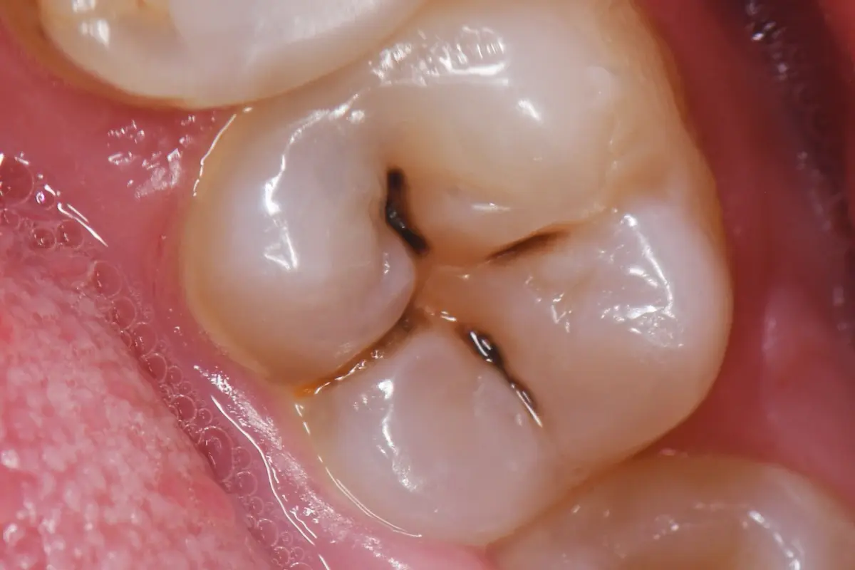 tooth filling cost with insurance