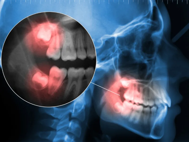 treating tooth pain