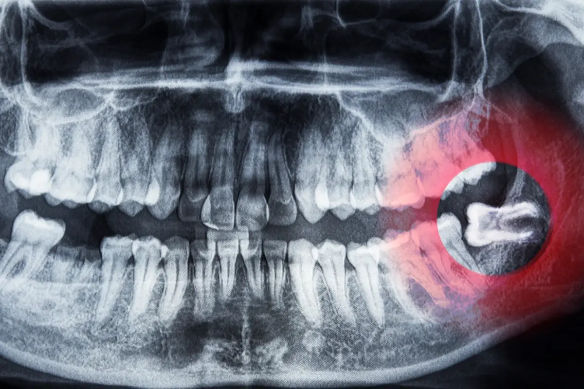 what are wisdom teeth