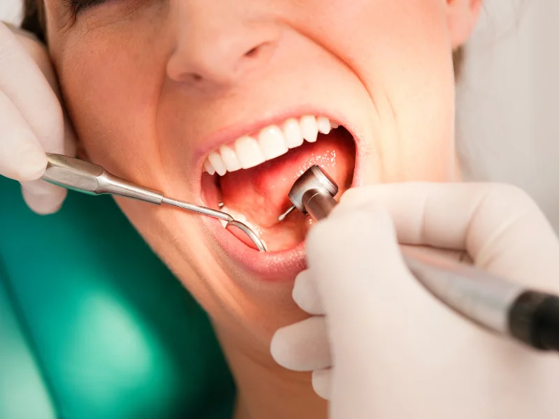 coffee after fluoride treatment