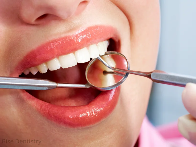 dental cleaning time